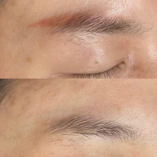 Brow Reversal